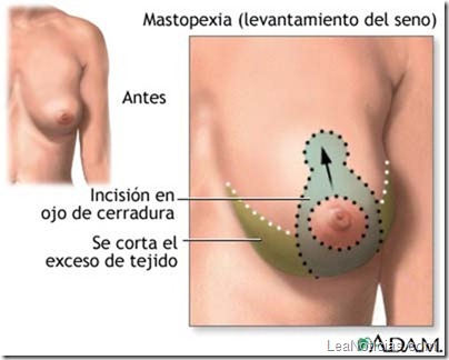 cirugia-escote-perfecto-4